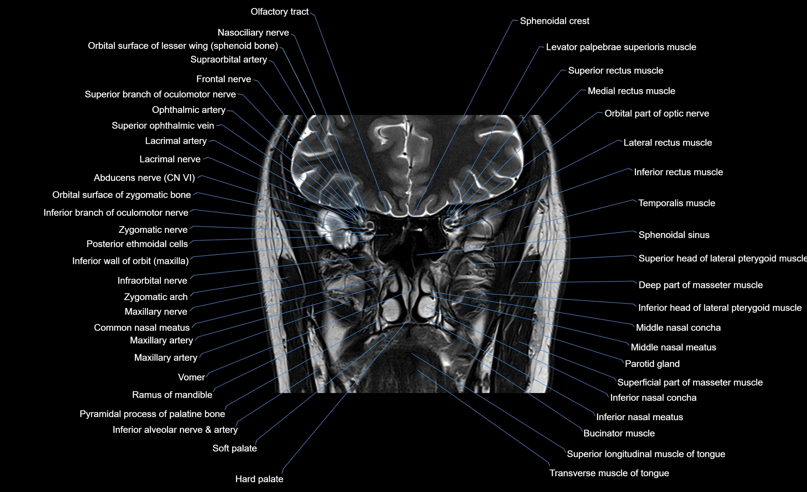 MRI face & paranasal sinuses(PNS) labelled  coronal  cross sectional anatomy 3T radiology  image-img-00001-00028.webp